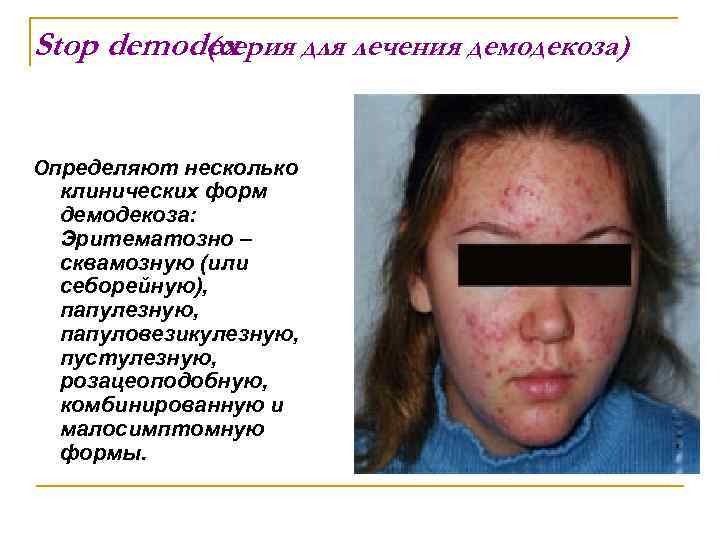 Stop demodex (серия для лечения демодекоза) Определяют несколько клинических форм демодекоза: Эритематозно – сквамозную