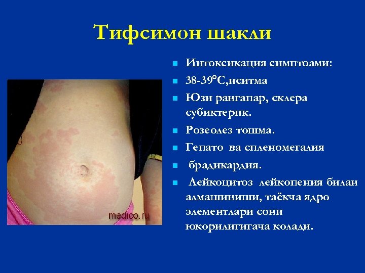 Тифсимон шакли n n n n Интоксикация симптоами: 38 -39 С, иситма Юзи рангапар,