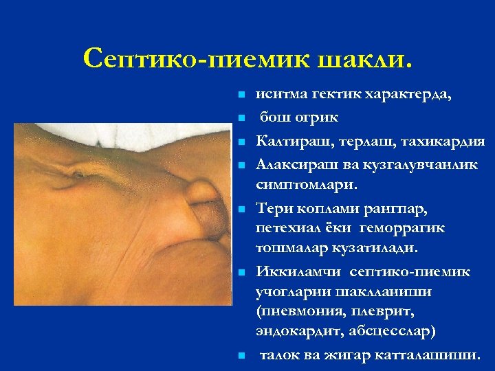 Септико-пиемик шакли. n n n n иситма гектик характерда, бош огрик Калтираш, терлаш, тахикардия