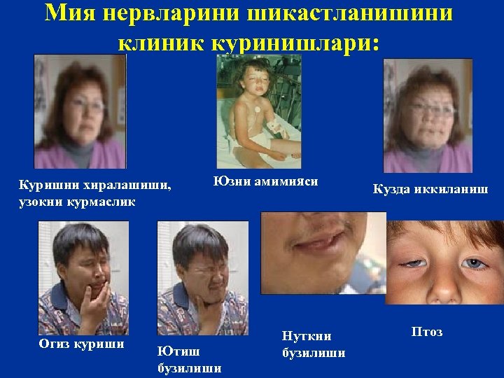 Мия нервларини шикастланишини клиник куринишлари: Куришни хиралашиши, узокни курмаслик Огиз куриши Юзни амимияси Ютиш