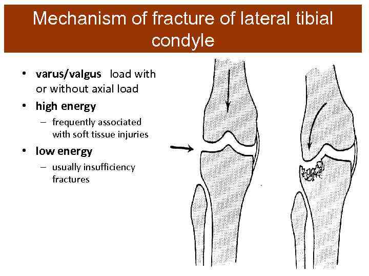 Mechanism of fracture of lateral tibial condyle • varus/valgus load with or without axial