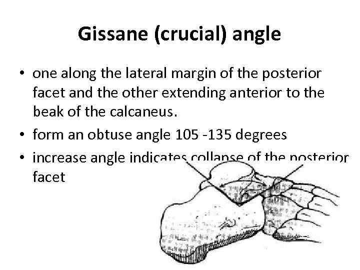 Gissane (crucial) angle • one along the lateral margin of the posterior facet and