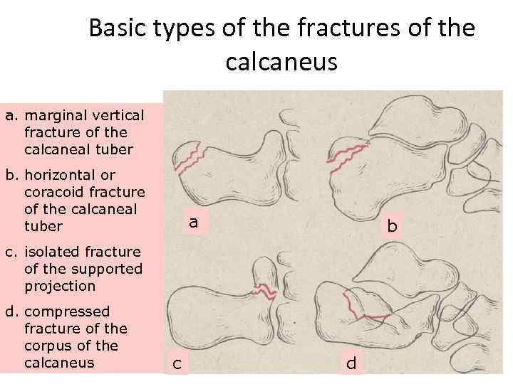 Basic types of the fractures of the calcaneus a. marginal vertical fracture of the