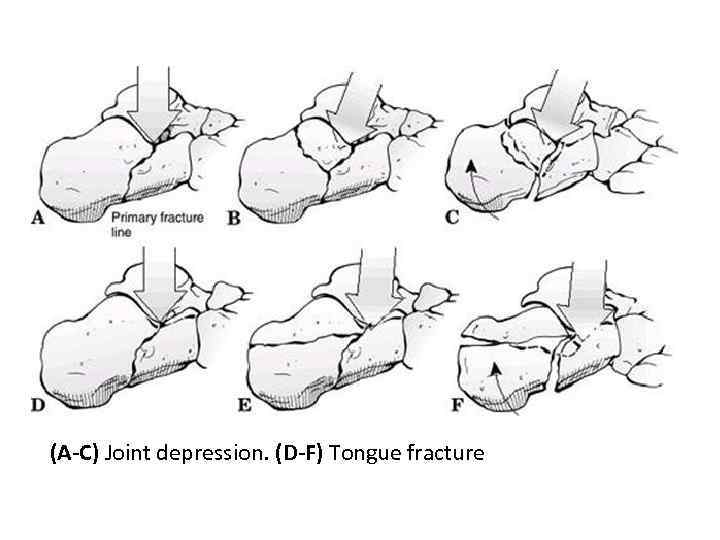 (A-C) Joint depression. (D-F) Tongue fracture 