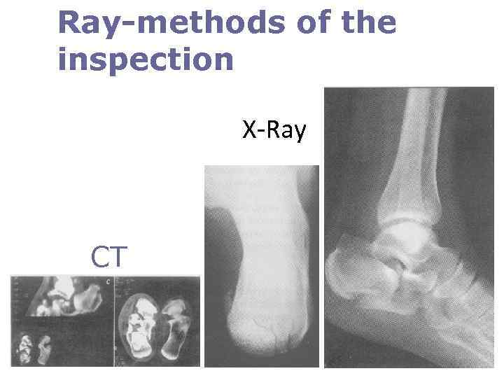 Ray-methods of the inspection X-Ray CT 