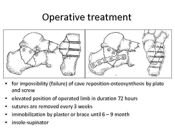 Operative treatment • for impossibility (failure) of cave reposition-osteosynthesis by plate and screw •