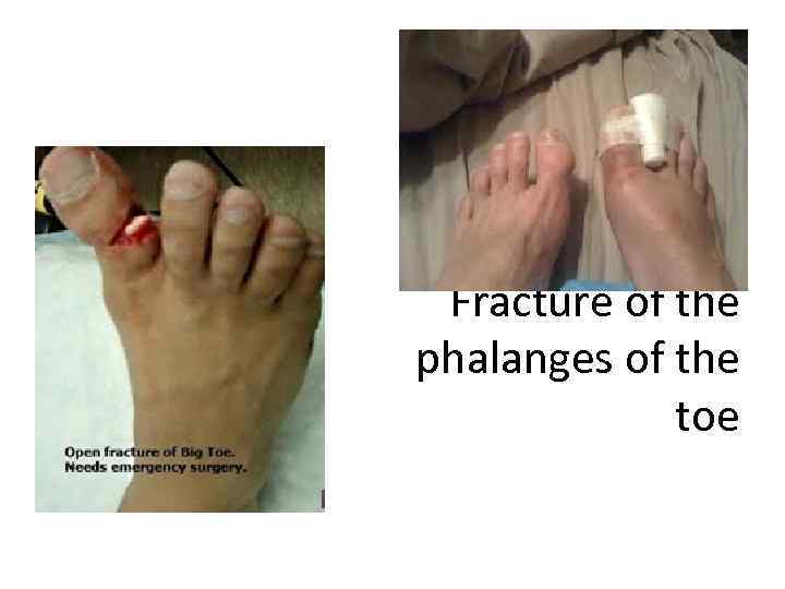 Fracture of the phalanges of the toe 