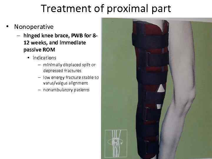 Treatment of proximal part • Nonoperative – hinged knee brace, PWB for 812 weeks,
