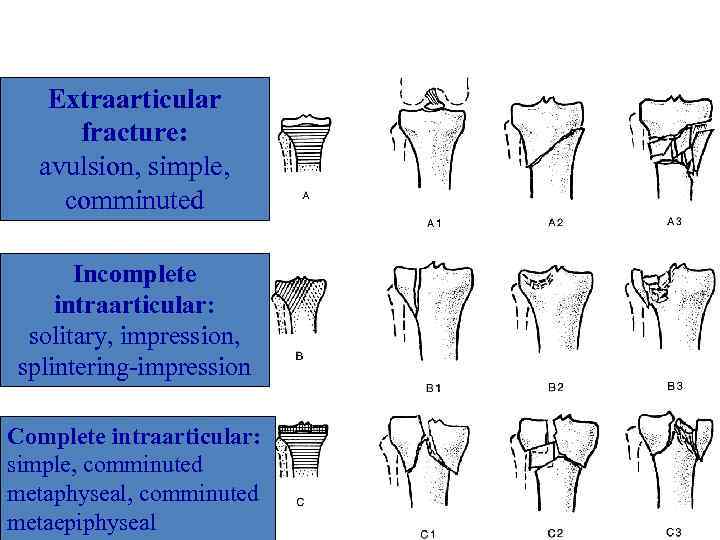 Classification AO of proximal part of leg’s bones Extraarticular fracture: avulsion, simple, comminuted Incomplete