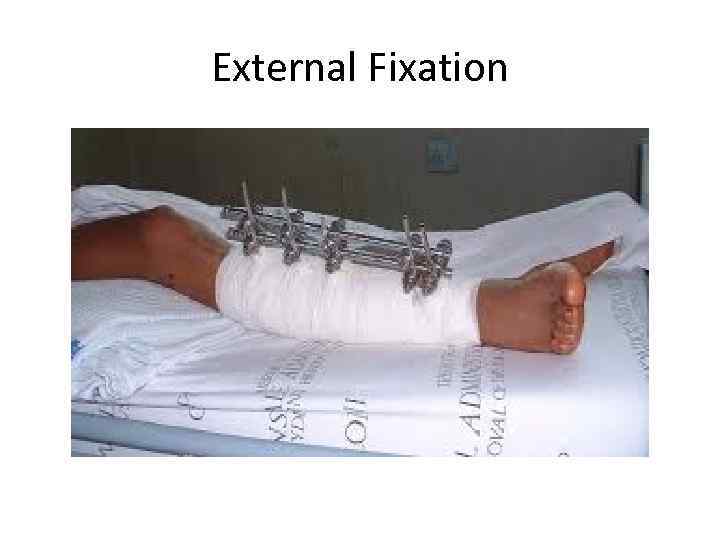 External Fixation 