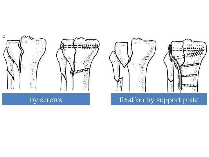 Variants of osteosynthesis at fractures of proximal part of bones‘ leg by screws fixation