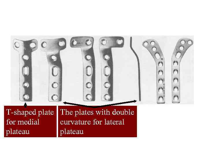 The types of supporting plates for fractures of a tibial plateau Т-shaped plate The
