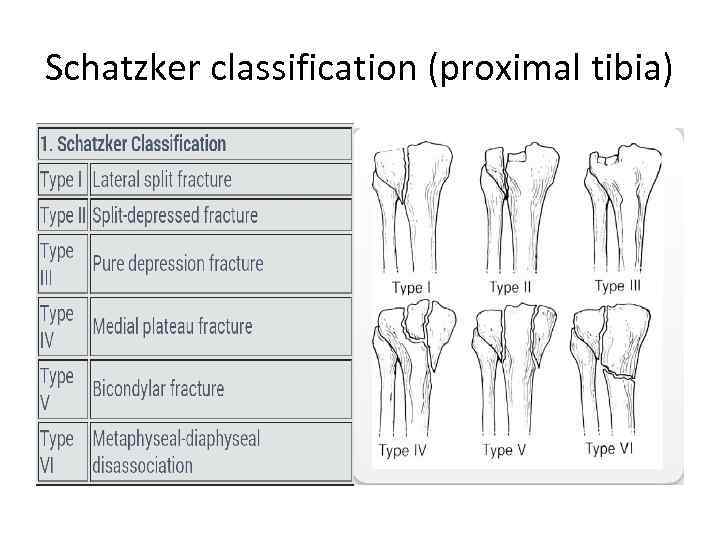 Schatzker classification (proximal tibia) 