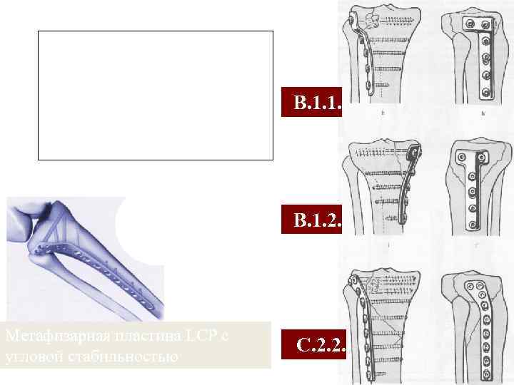 Different types of support plates for fractures of the tibial plateau В. 1. 1.