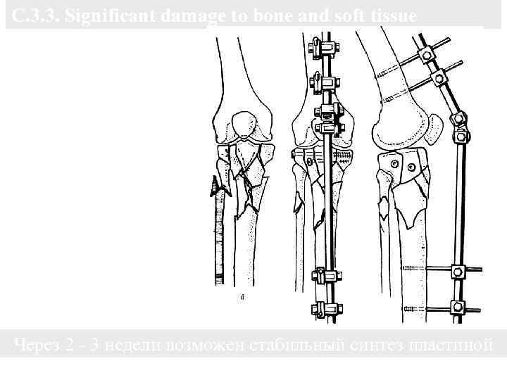 С. 3. 3. Significant damage to bone and soft tissue Reposition the result ligaments
