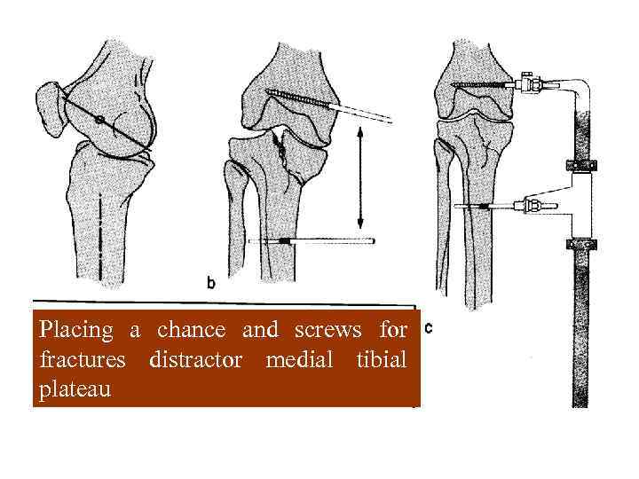 Placing a chance and screws for fractures distractor medial tibial plateau 