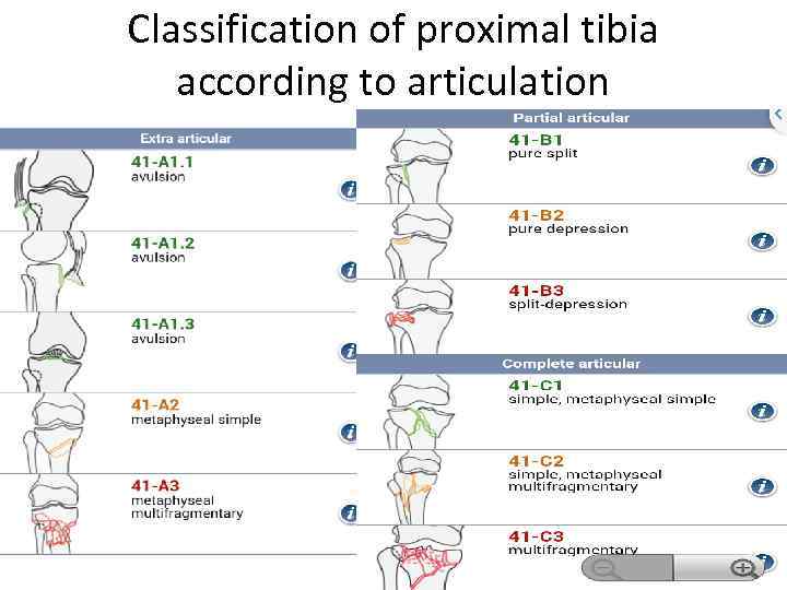 Classification of proximal tibia according to articulation 