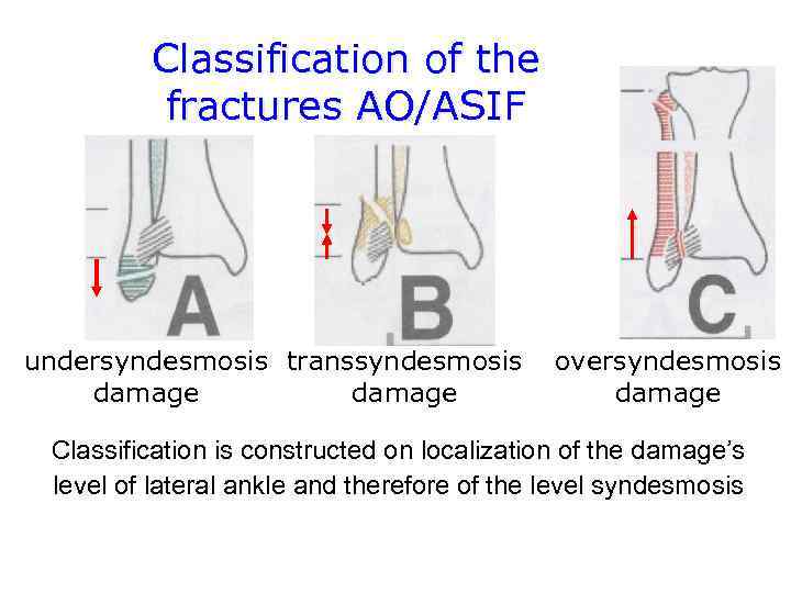 Classification of the fractures AO/ASIF undersyndesmosis transsyndesmosis damage oversyndesmosis damage Classification is constructed on