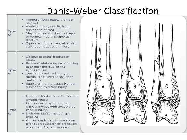 Danis-Weber Classification 