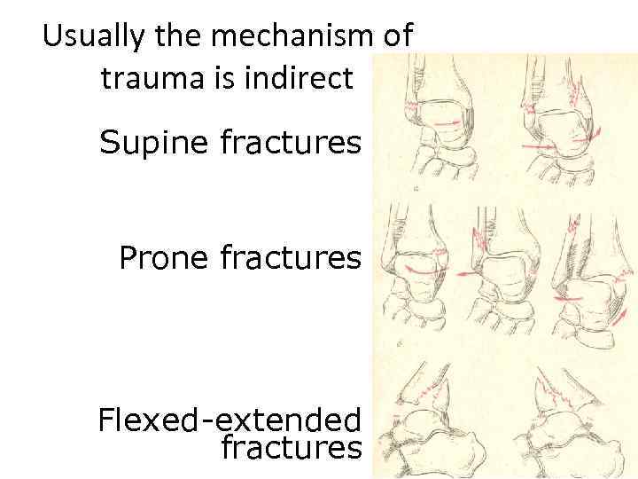 Usually the mechanism of trauma is indirect Supine fractures Prone fractures Flexed-extended fractures 