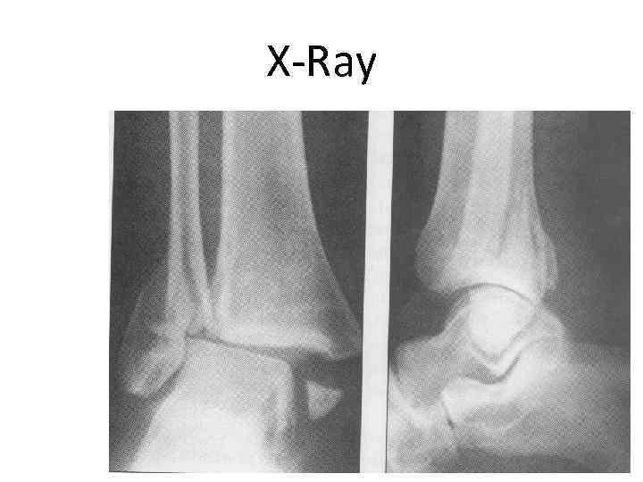 X-Ray 