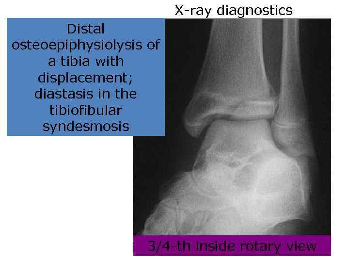 X-ray diagnostics Distal osteoepiphysiolysis of a tibia with displacement; diastasis in the tibiofibular syndesmosis
