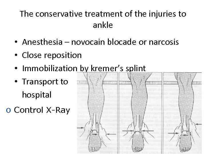 The conservative treatment of the injuries to ankle • • Anesthesia – novocain blocade