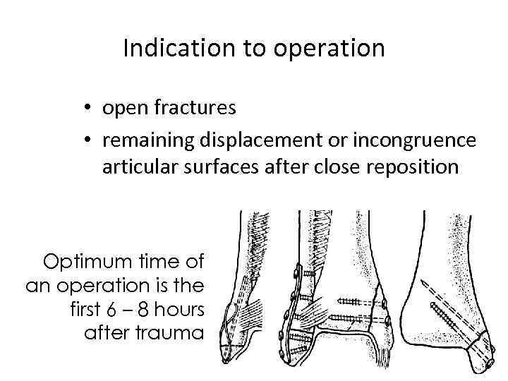 Indication to operation • open fractures • remaining displacement or incongruence articular surfaces after