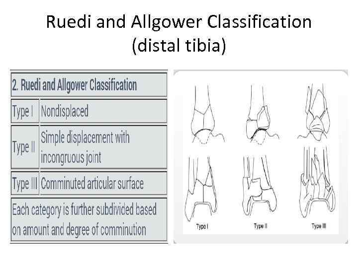 Ruedi and Allgower Classification (distal tibia) 