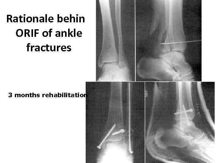 Rationale behind ORIF of ankle fractures 3 months rehabilitation 