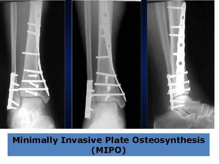 Minimally Invasive Plate Osteosynthesis (MIPO) 