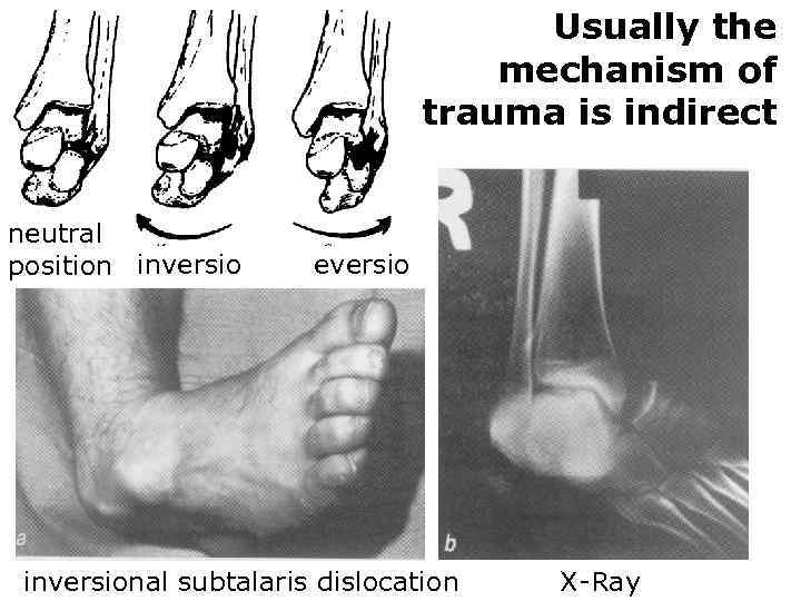 Usually the mechanism of trauma is indirect neutral position inversio eversio inversional subtalaris dislocation