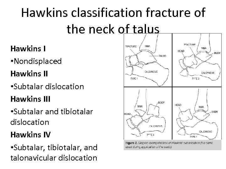 Hawkins classification fracture of the neck of talus Hawkins I • Nondisplaced Hawkins II