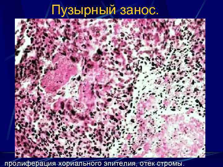 Пузырный занос. пролиферация хориального эпителия, отек стромы. 