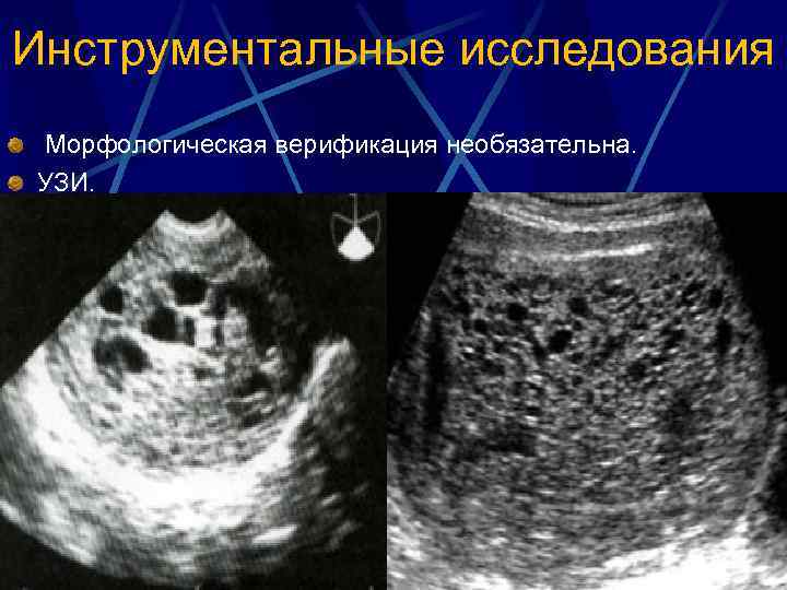 Инструментальные исследования Морфологическая верификация необязательна. УЗИ. 