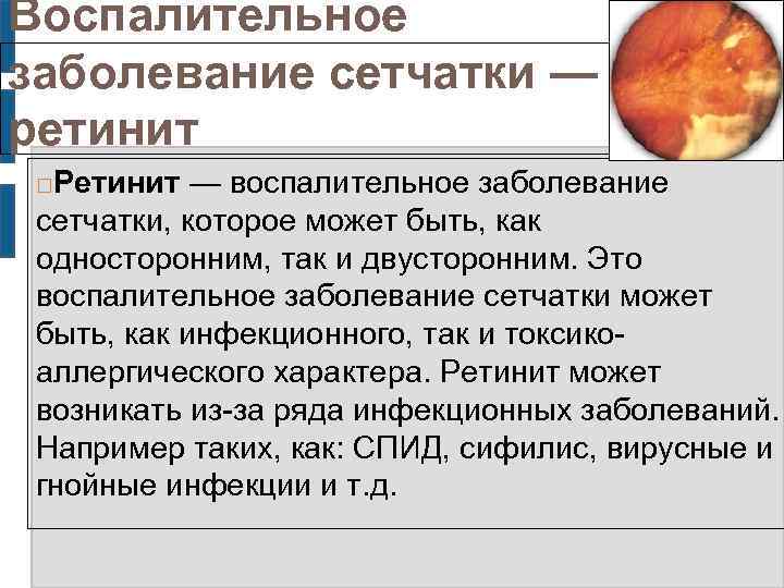 Воспалительные заболевания сетчатки глаза