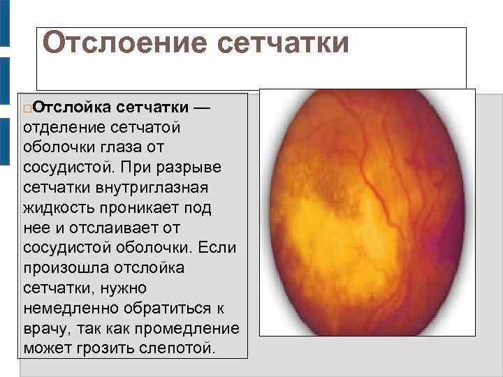 Отслоение сетчатки Отслойка сетчатки — отделение сетчатой оболочки глаза от сосудистой. При разрыве сетчатки