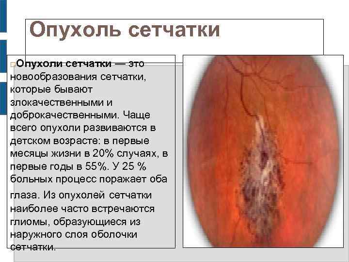 Опухоль сетчатки Опухоли сетчатки — это новообразования сетчатки, которые бывают злокачественными и доброкачественными. Чаще