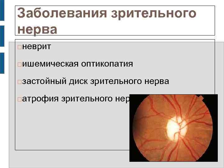 Заболевания зрительного нерва неврит ишемическая оптикопатия застойный диск зрительного нерва атрофия зрительного нерва 