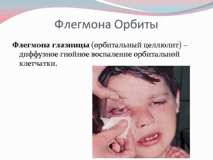 Флегмона Орбиты Флегмона глазницы (орбитальный целлюлит) – диффузное гнойное воспаление орбитальной клетчатки. 