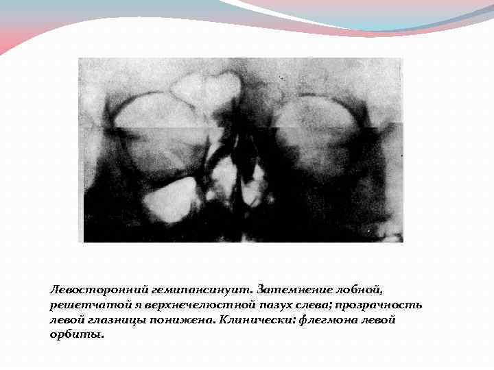 Левосторонний гемипансинуит. Затемнение лобной, решетчатой я верхнечелюстной пазух слева; прозрачность левой глазницы понижена. Клинически: