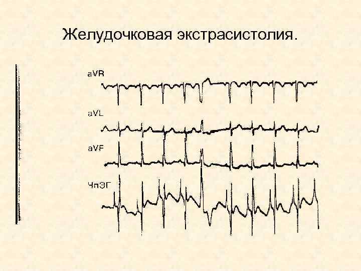 Желудочковая экстрасистолия. 