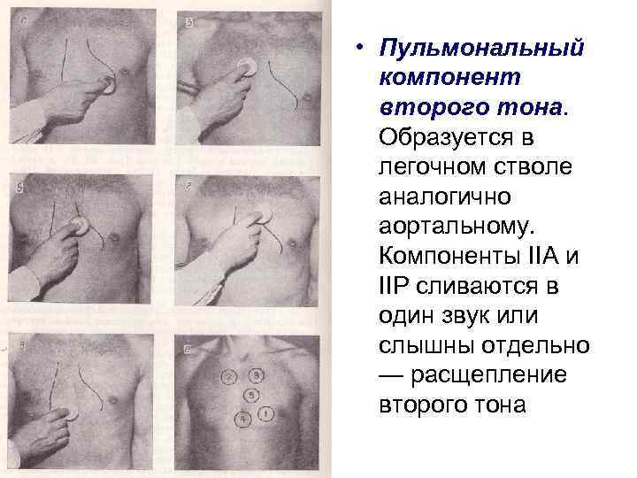  • Пульмональный компонент второго тона. Образуется в легочном стволе аналогично аортальному. Компоненты IIA