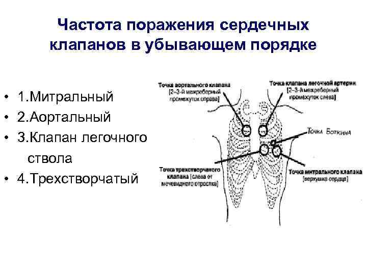 Частота поражения сердечных клапанов в убывающем порядке • 1. Митральный • 2. Аортальный •
