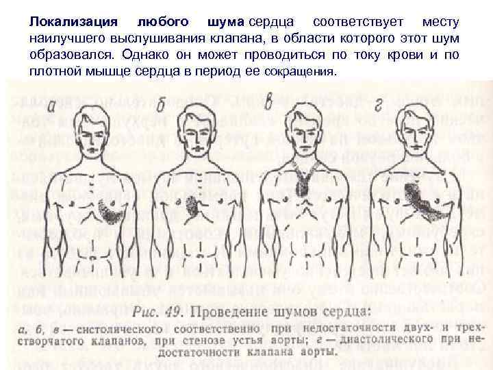 Локализация любого шума сердца соответствует месту наилучшего выслушивания клапана, в области которого этот шум