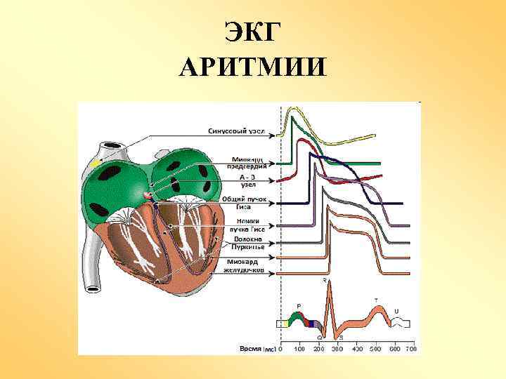 ЭКГ АРИТМИИ 