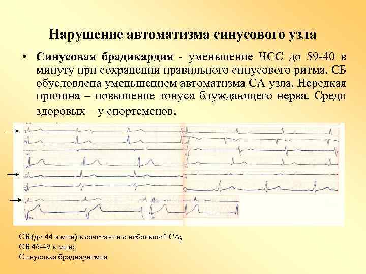 Синусовая брадикардия мкб