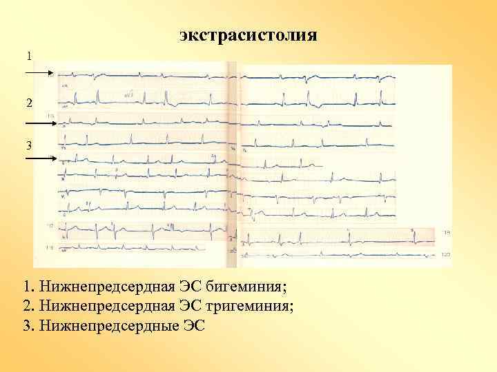 Нарушение ритма по типу бигеминии карта вызова