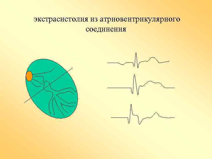 экстрасистолия из атриовентрикулярного соединения 