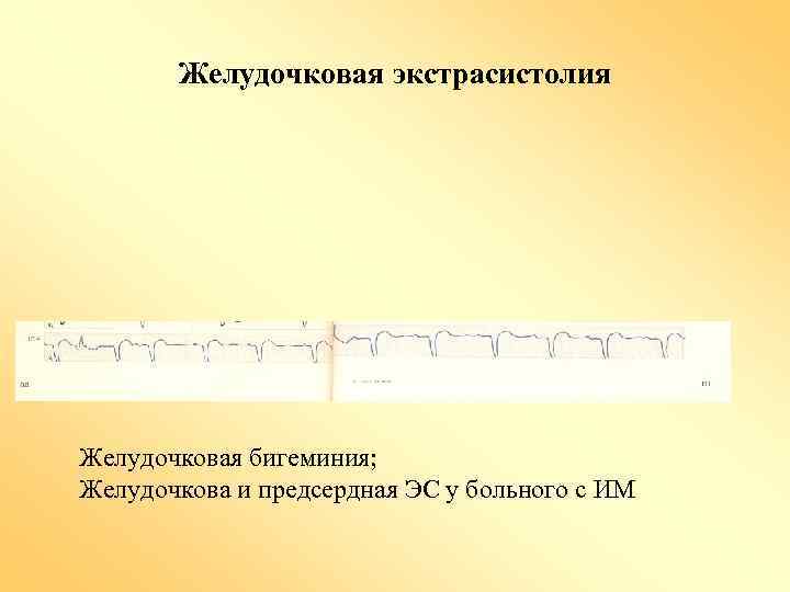 Желудочковая экстрасистолия Желудочковая бигеминия; Желудочкова и предсердная ЭС у больного с ИМ 